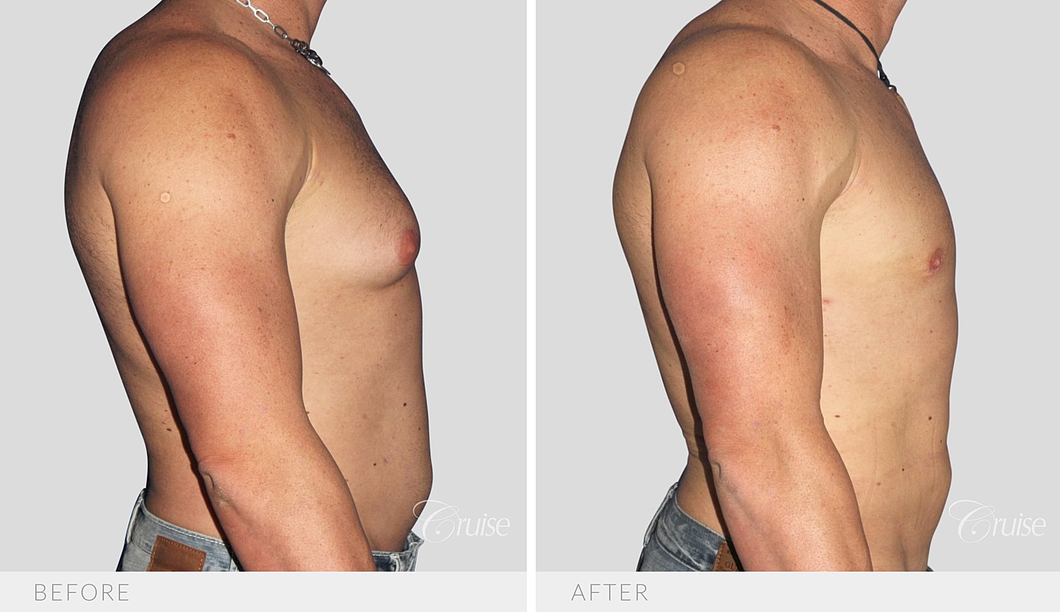 Side profile showing less chest projection after Type 3 gynecomastia surgery