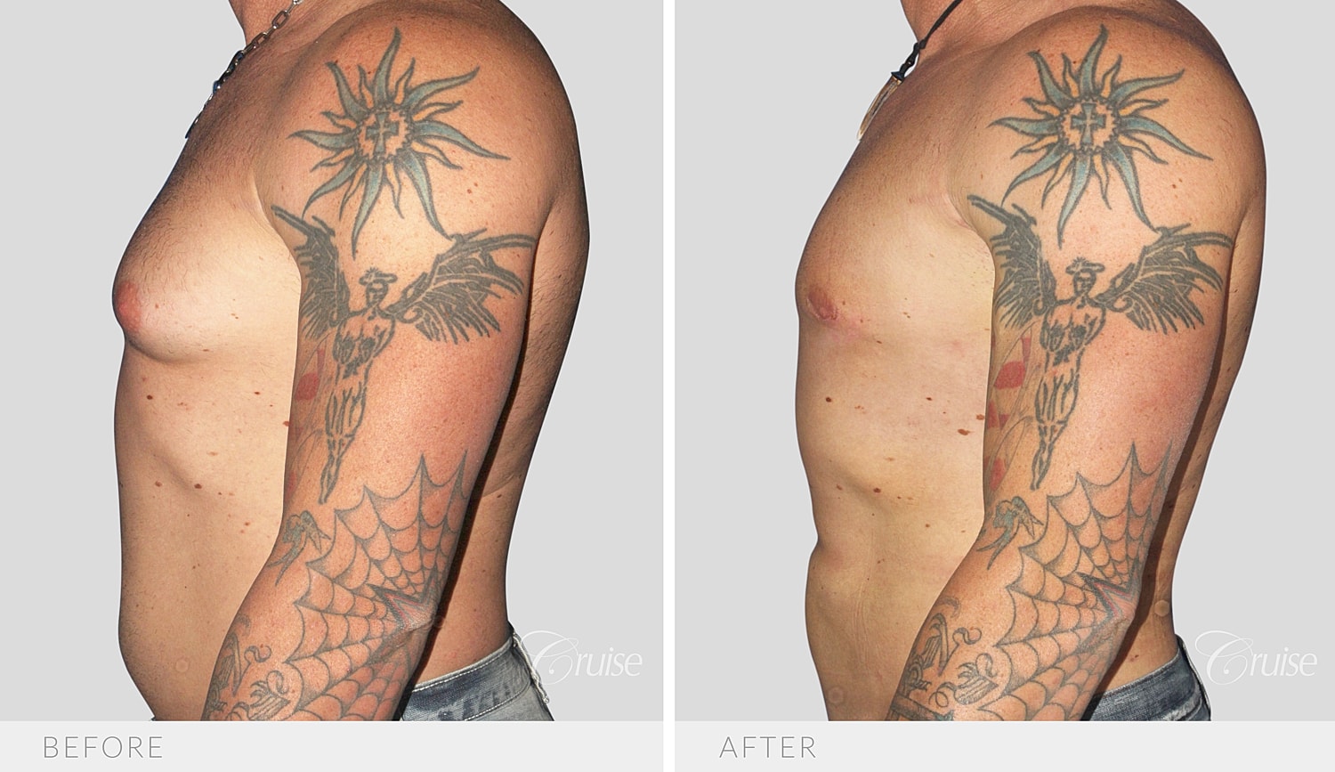 Opposite side profile after areola incision, gland removal and liposuction
