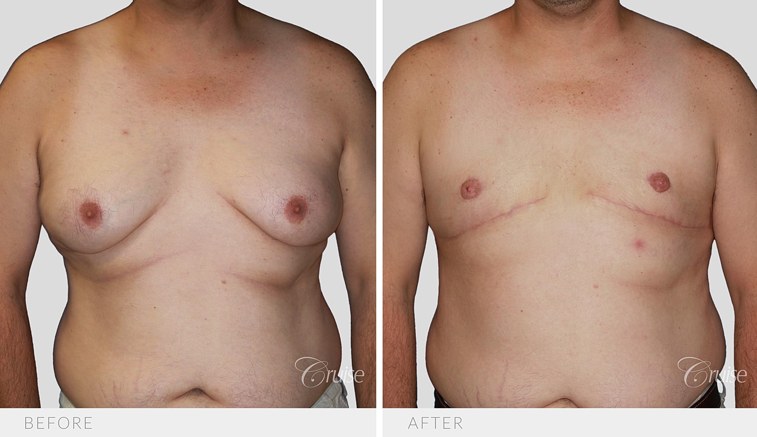 Front view of the chest before and after Type 5 gynecomastia surgery