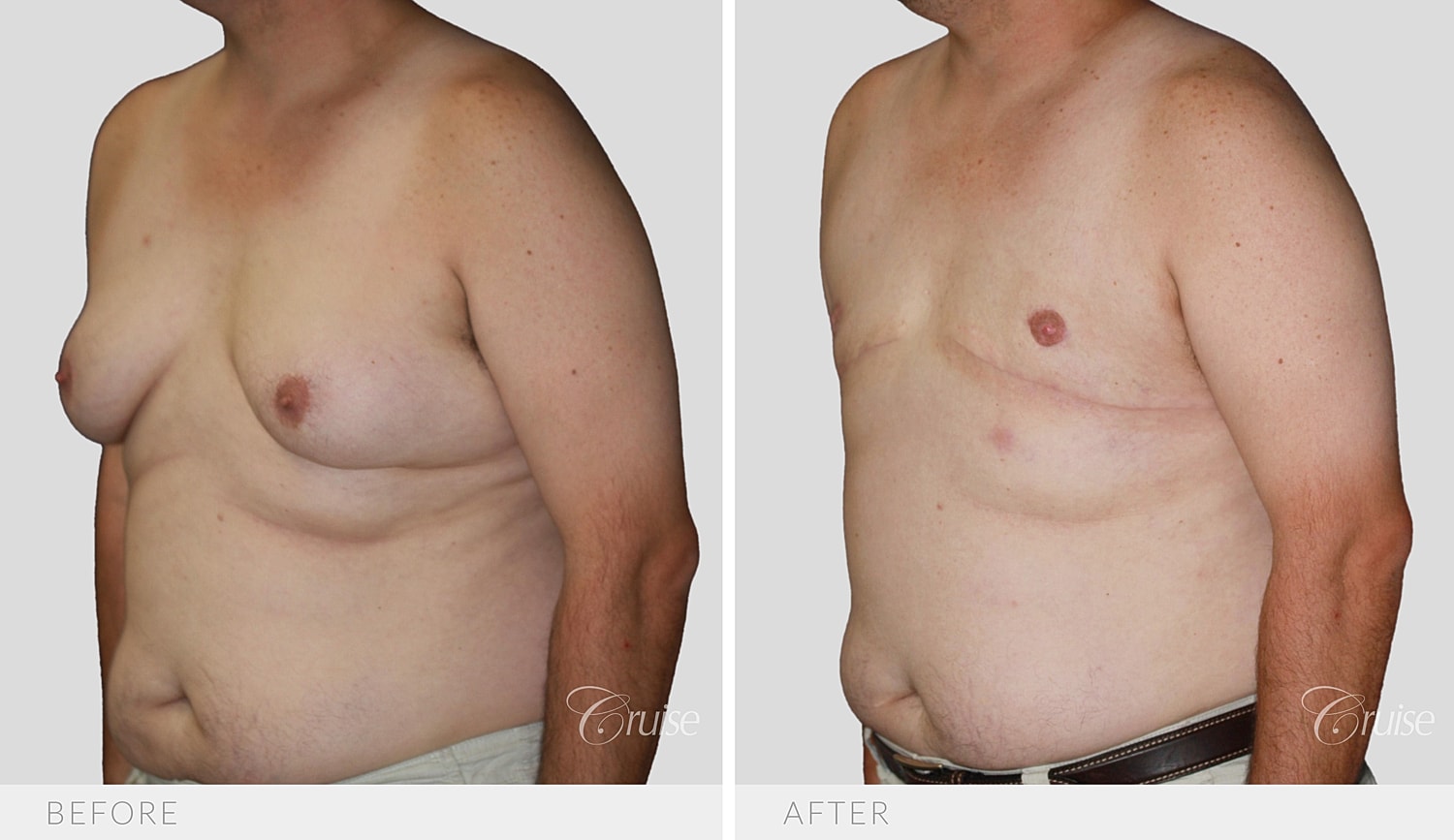 Angled view of the chest after tissue removal and free nipple grafts