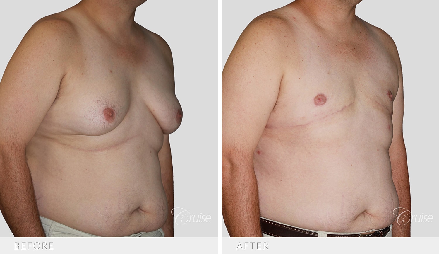 Opposite angled view showing the chest contour after surgery