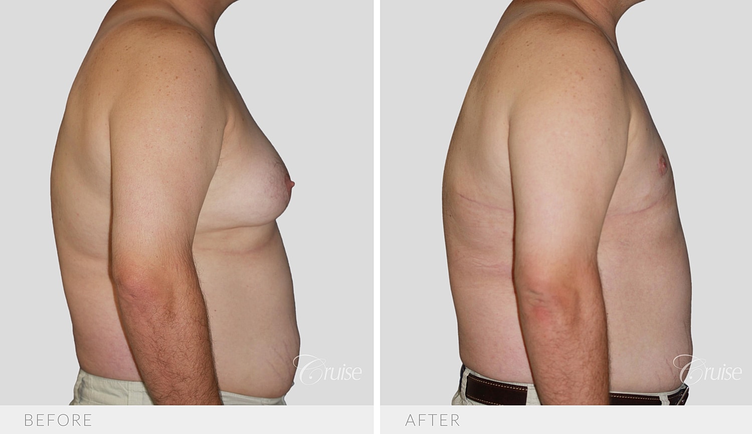 Side profile comparing chest projection before and after surgery