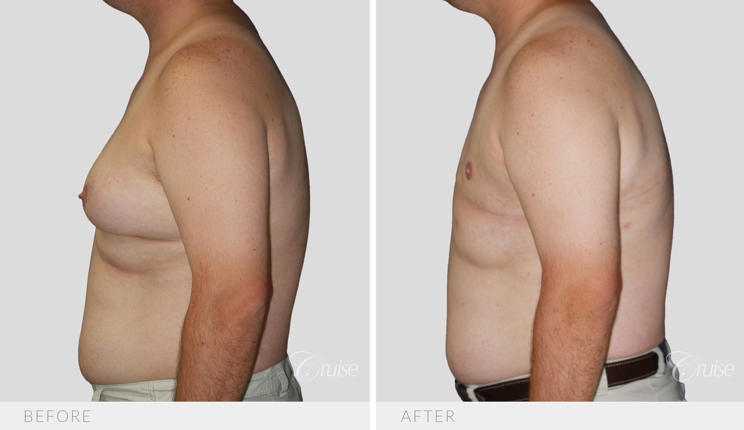 Opposite side profile after skin removal and free nipple grafts