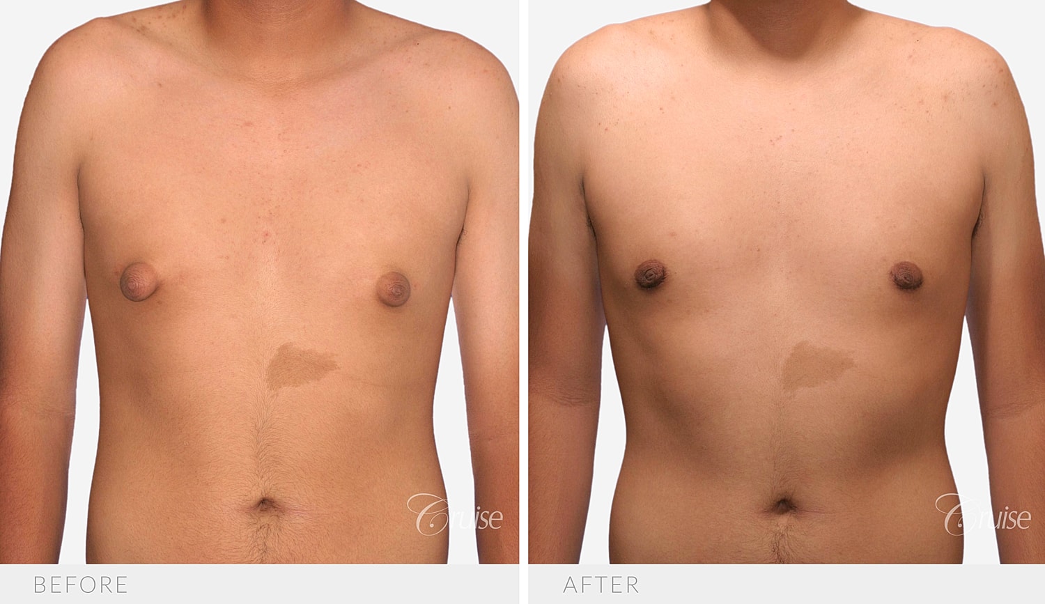 Front view of the chest before and after Type 1 gynecomastia surgery