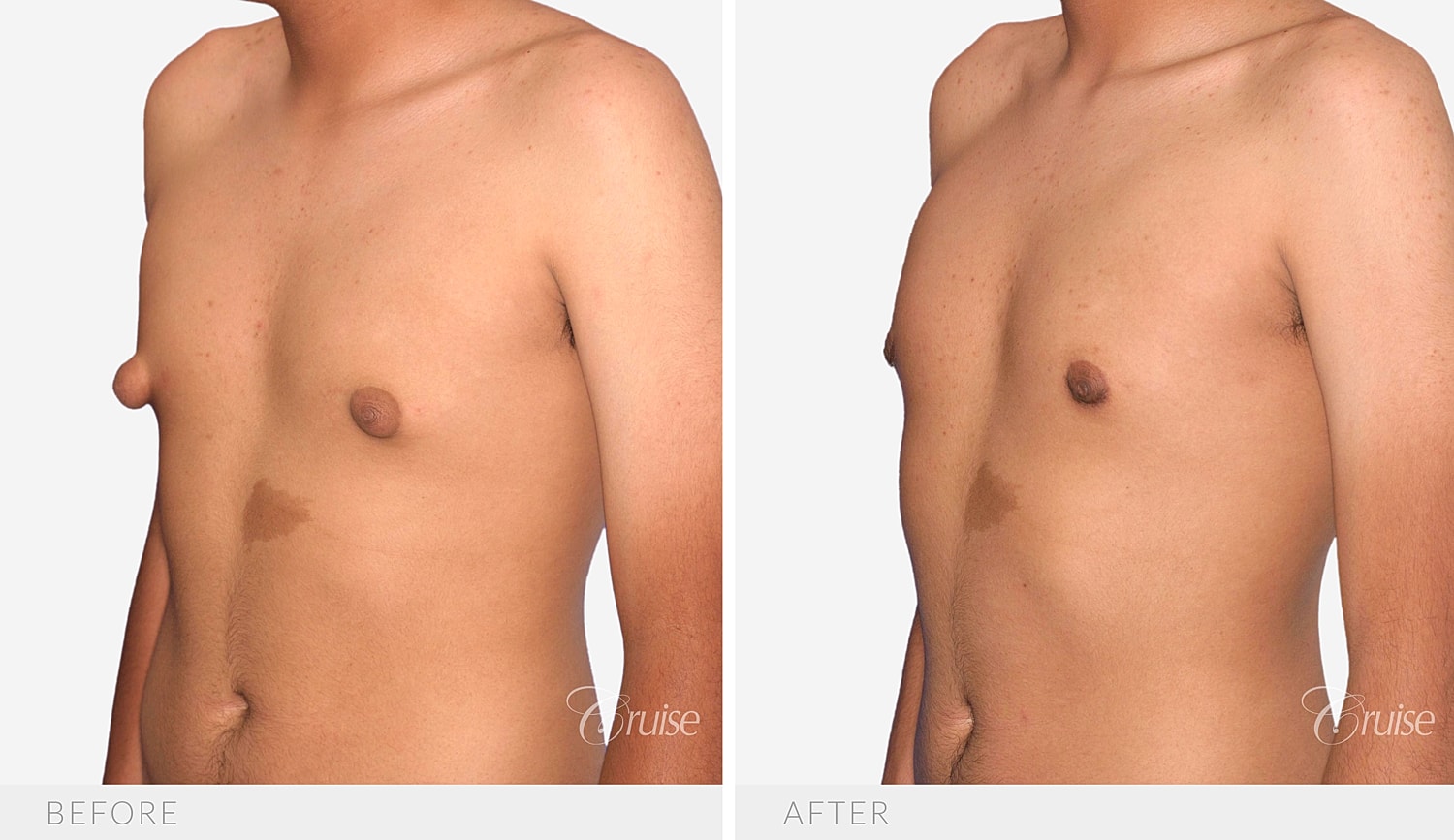 Angled view showing less nipple and chest projection after two-stage surgery