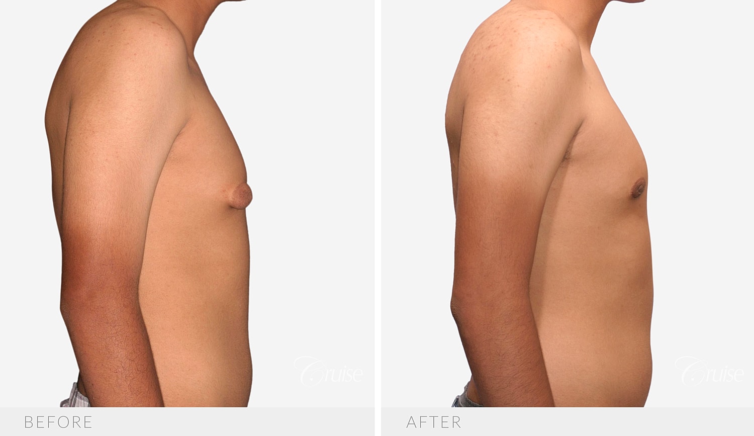 Side profile comparing nipple projection before and after surgery