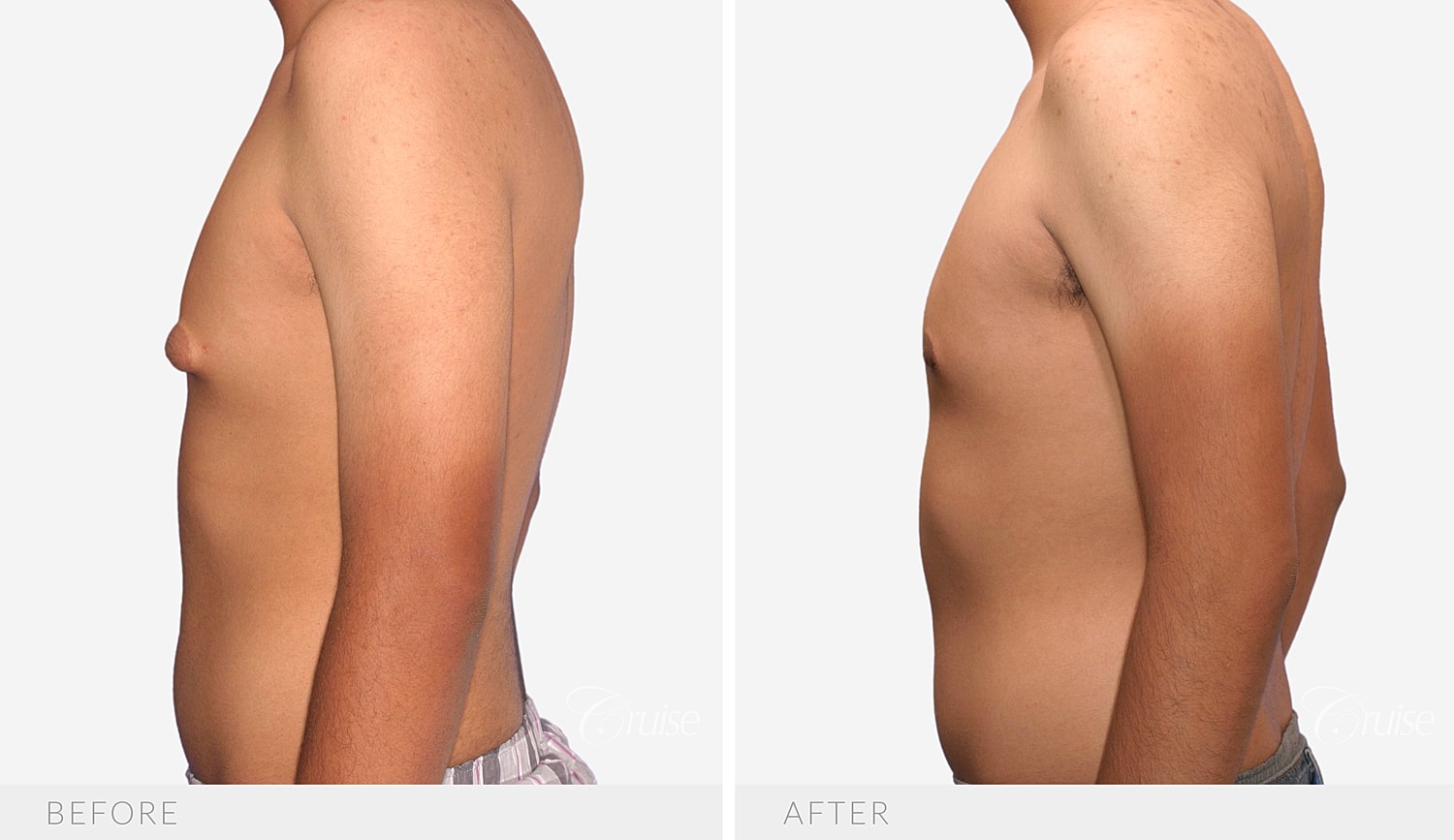 Opposite side profile after correction of puffy nipples
