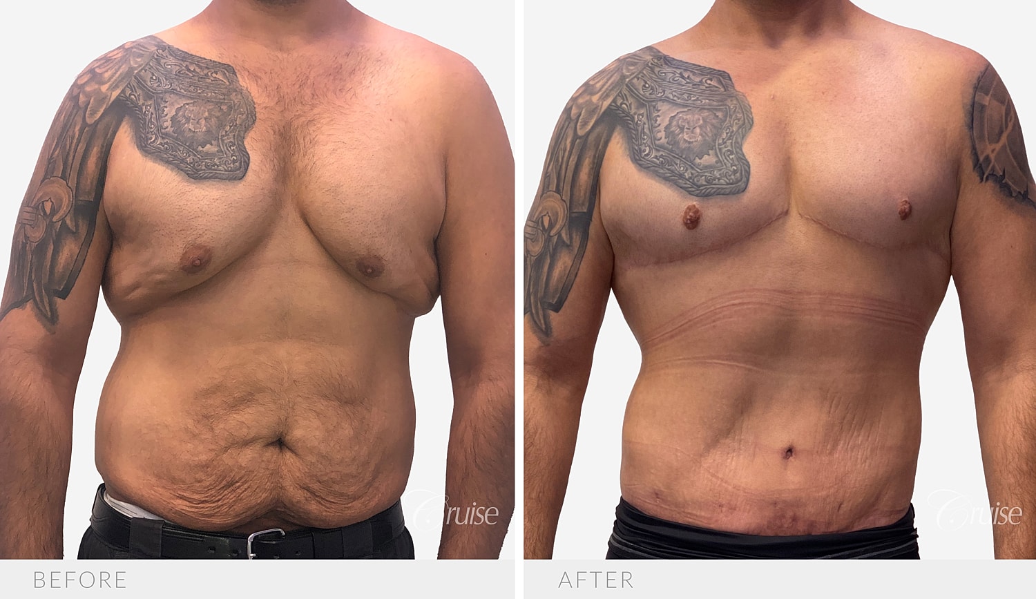 Front view of the chest and torso before and after a circumferential chest lift