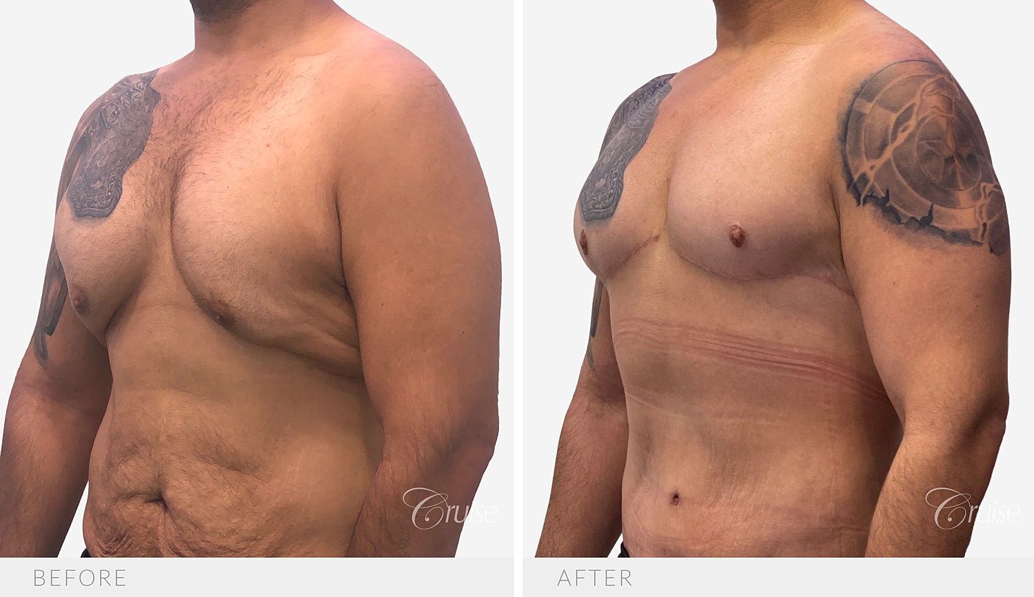 Angled view of the chest contour after a chest lift with free nipple grafts