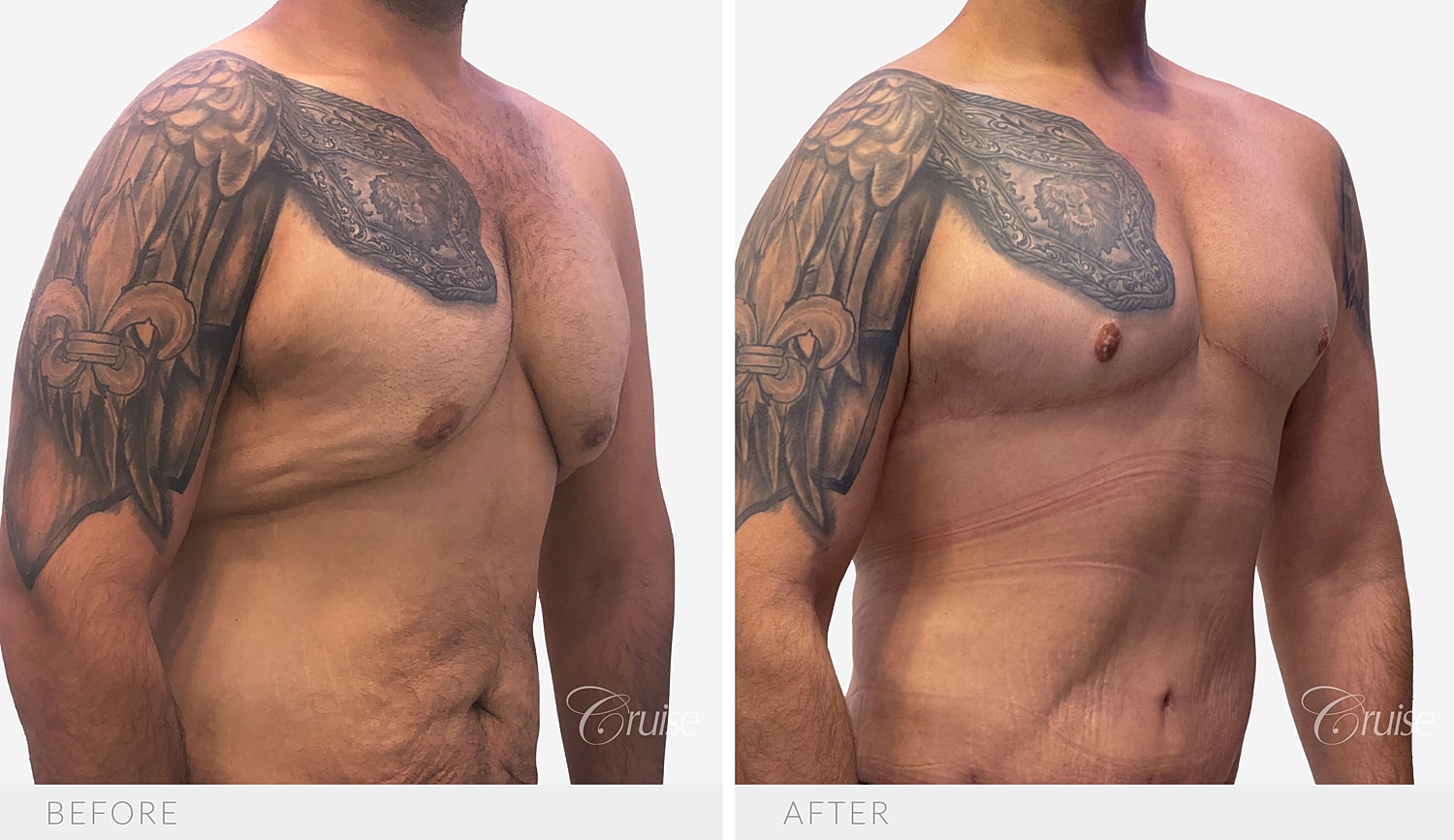 Opposite angled view of the chest and sides after removal of excess skin