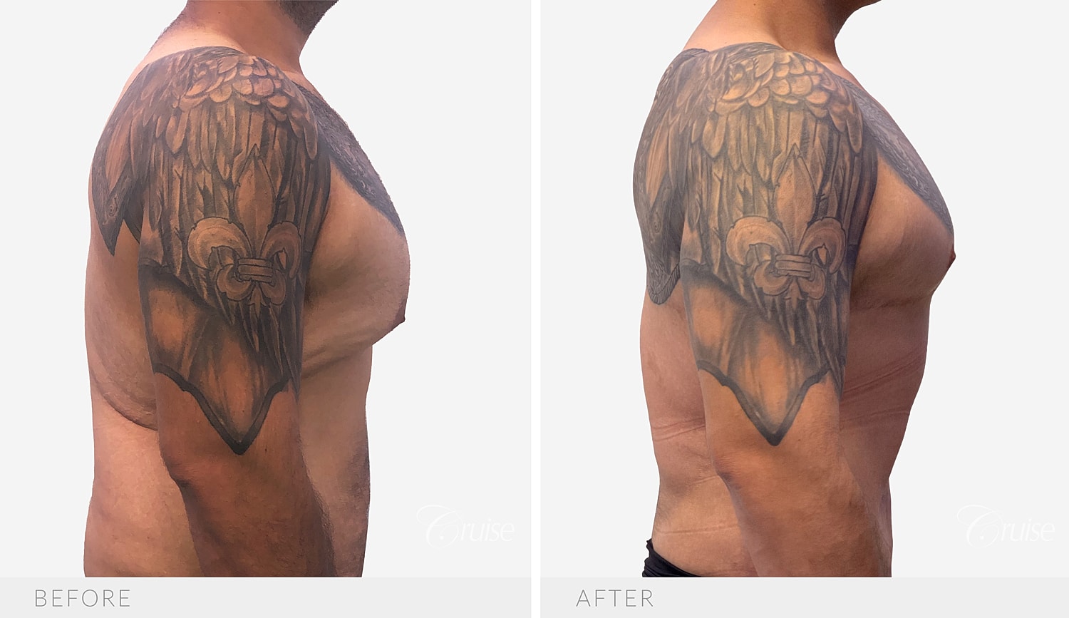 Side profile comparing chest projection before and after surgery