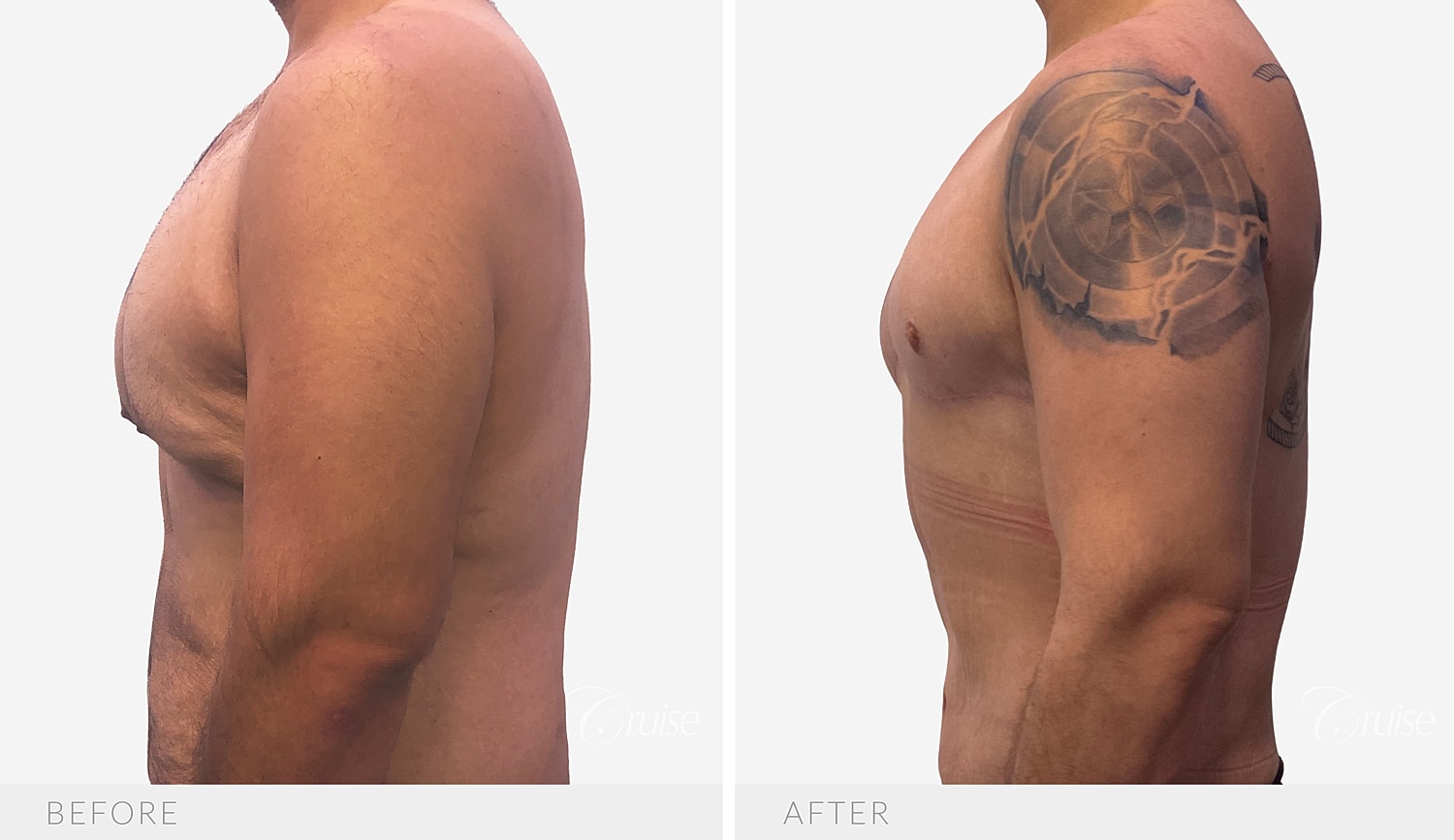 Opposite side profile after a circumferential chest lift and axillary liposuction