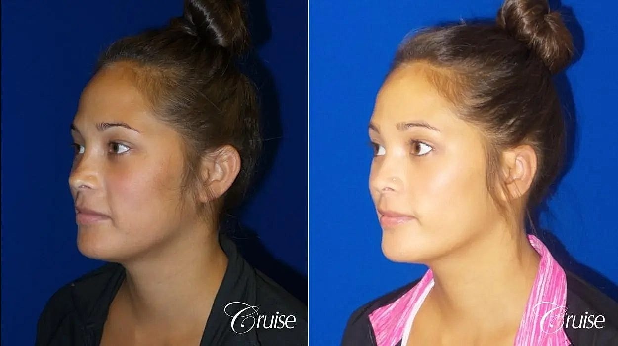 Otoplasty Earlobe Repair Before & After