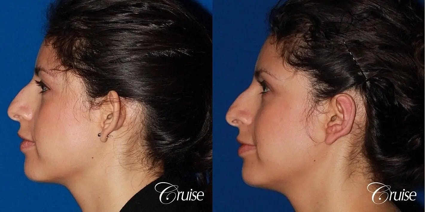 Otoplasty Earlobe Repair Before & After