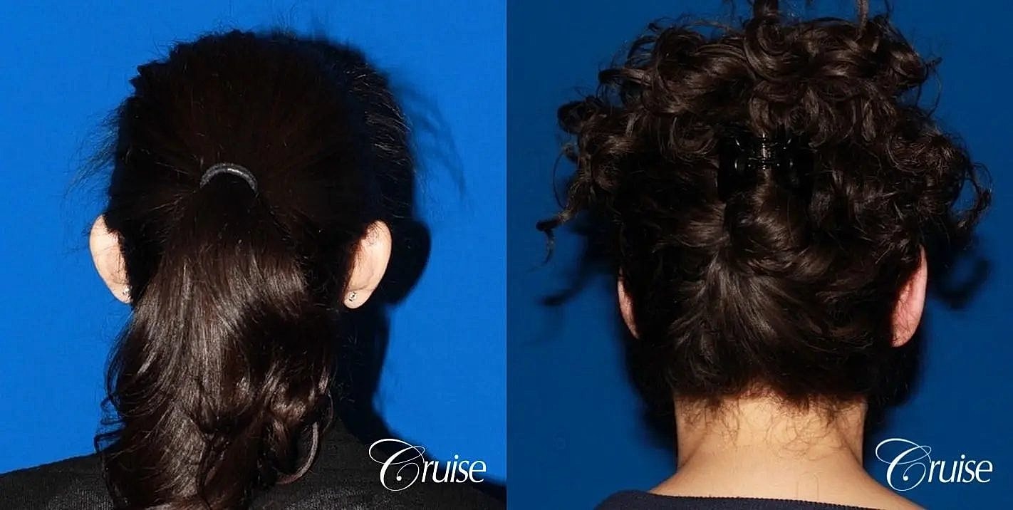 Otoplasty Earlobe Repair Before & After