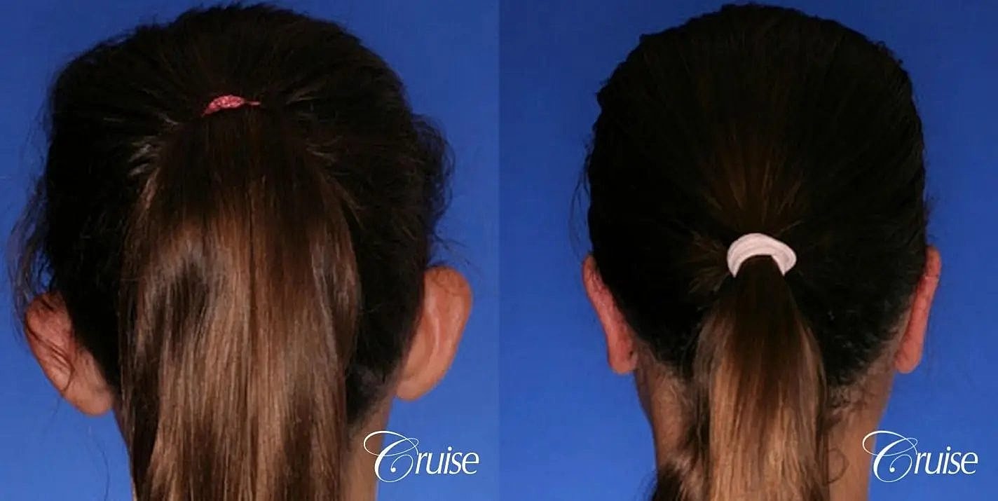 Otoplasty Earlobe Repair Before & After