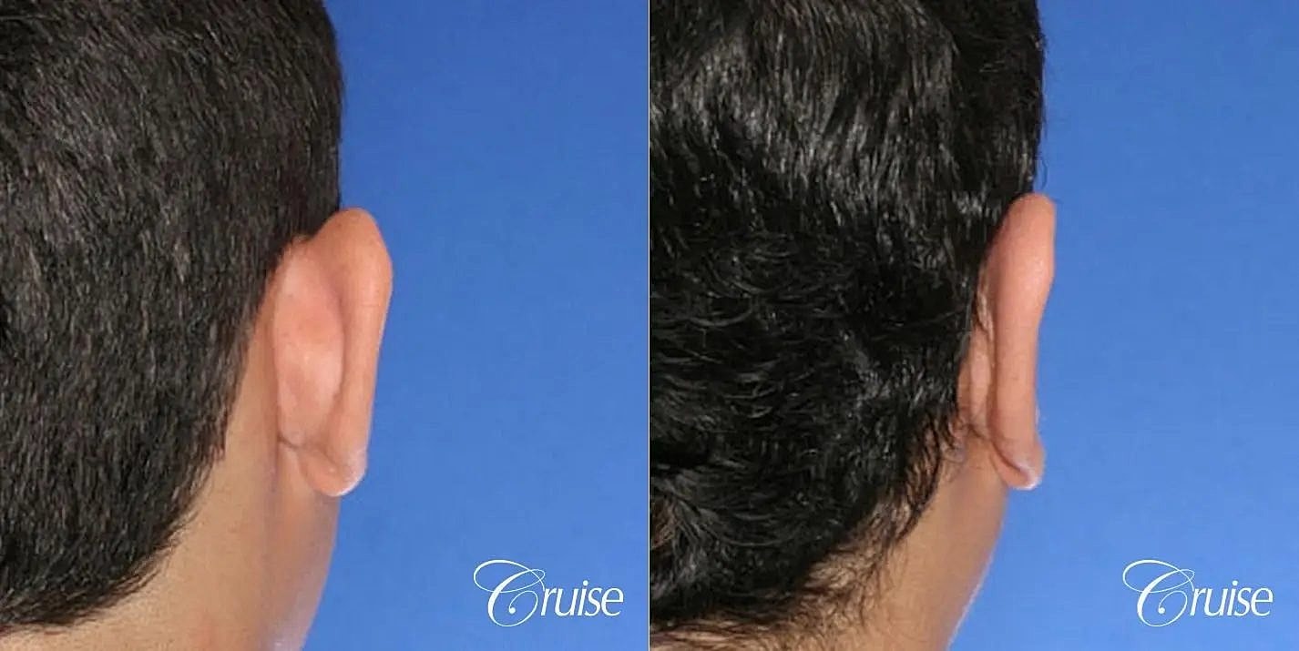 Otoplasty Earlobe Repair Before & After