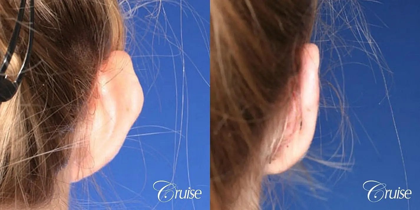 Otoplasty Earlobe Repair Before & After