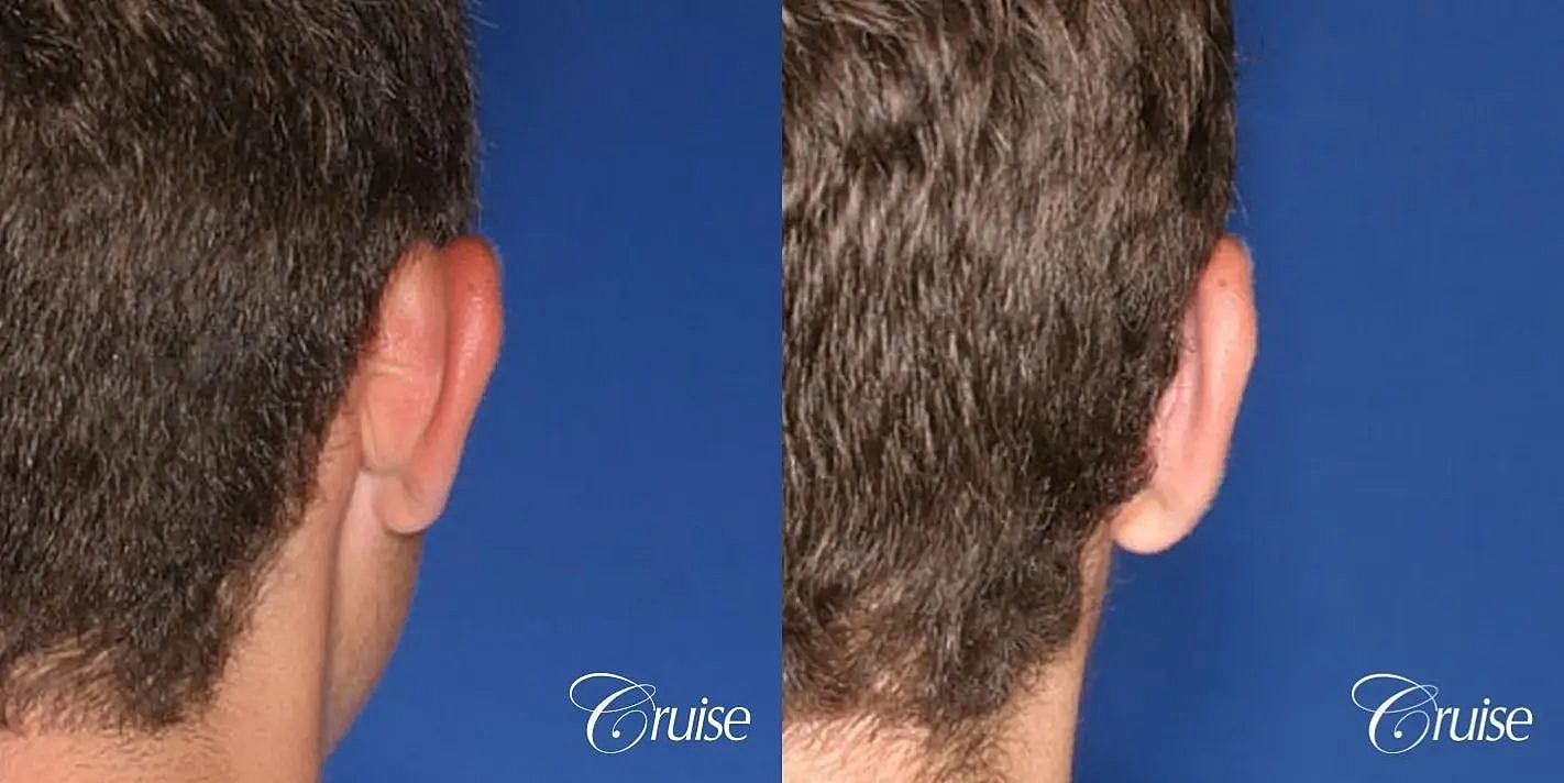 Otoplasty Earlobe Repair Before & After
