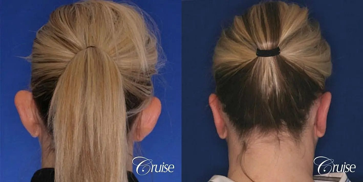 Otoplasty Earlobe Repair Before & After