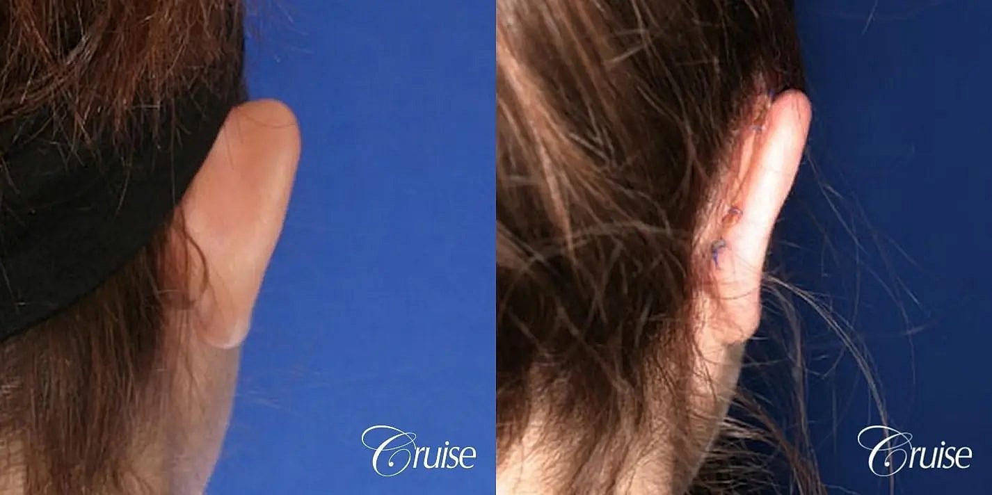 Otoplasty Earlobe Repair Before & After