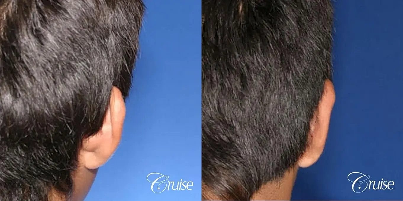 Otoplasty Earlobe Repair Before & After