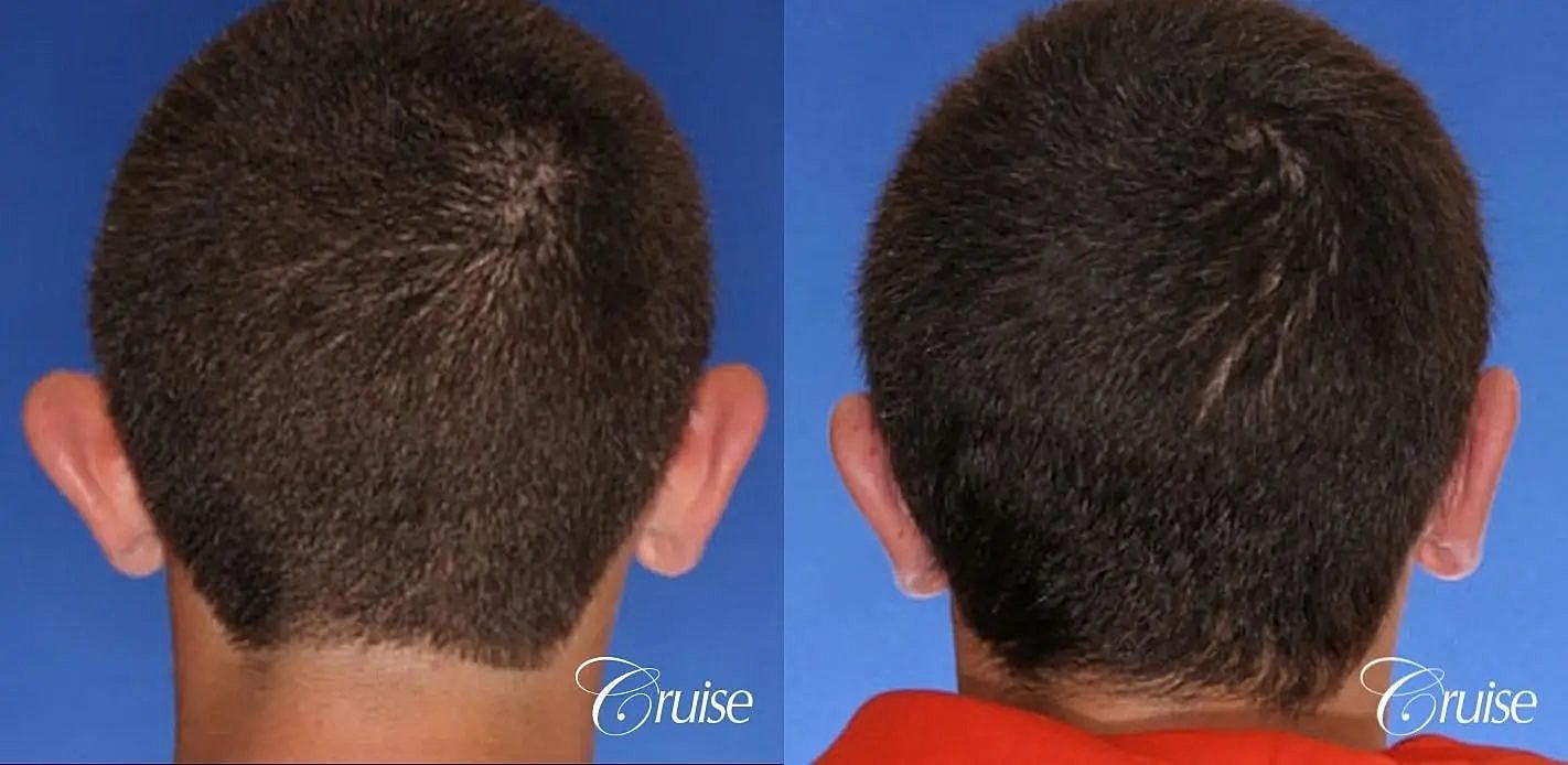 Otoplasty Earlobe Repair Before & After