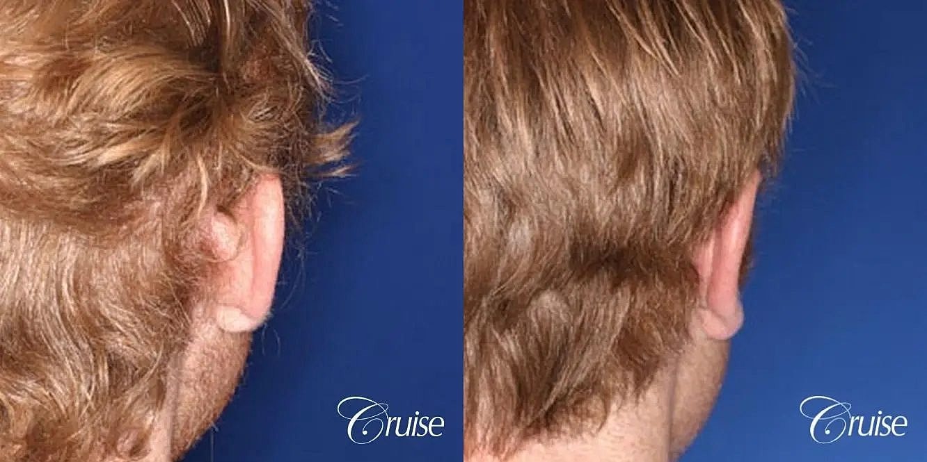 Otoplasty Earlobe Repair Before & After