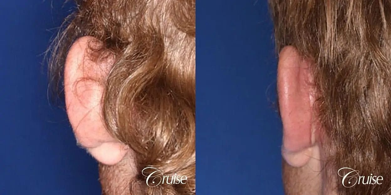 Otoplasty Earlobe Repair Before & After