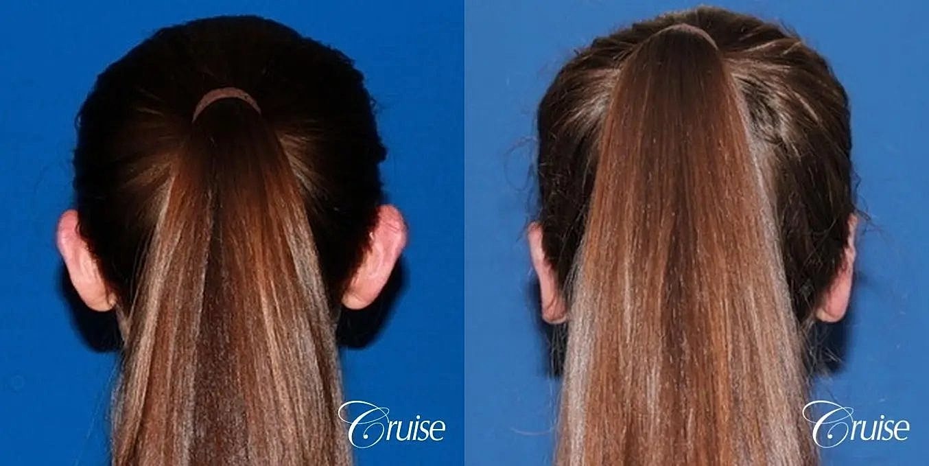 Otoplasty Earlobe Repair Before & After