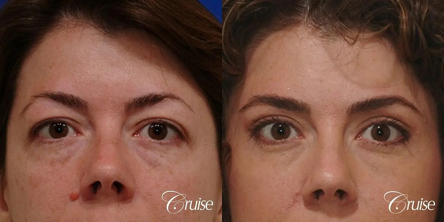 Blepharoplasty Before & After