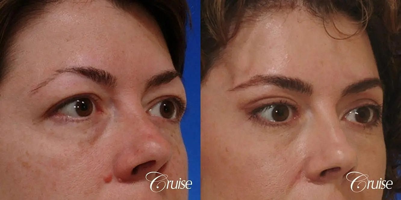Blepharoplasty Before & After