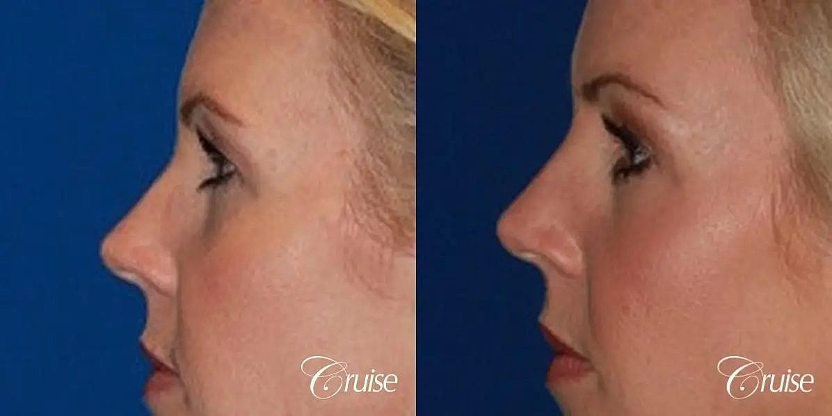 Blepharoplasty Before & After
