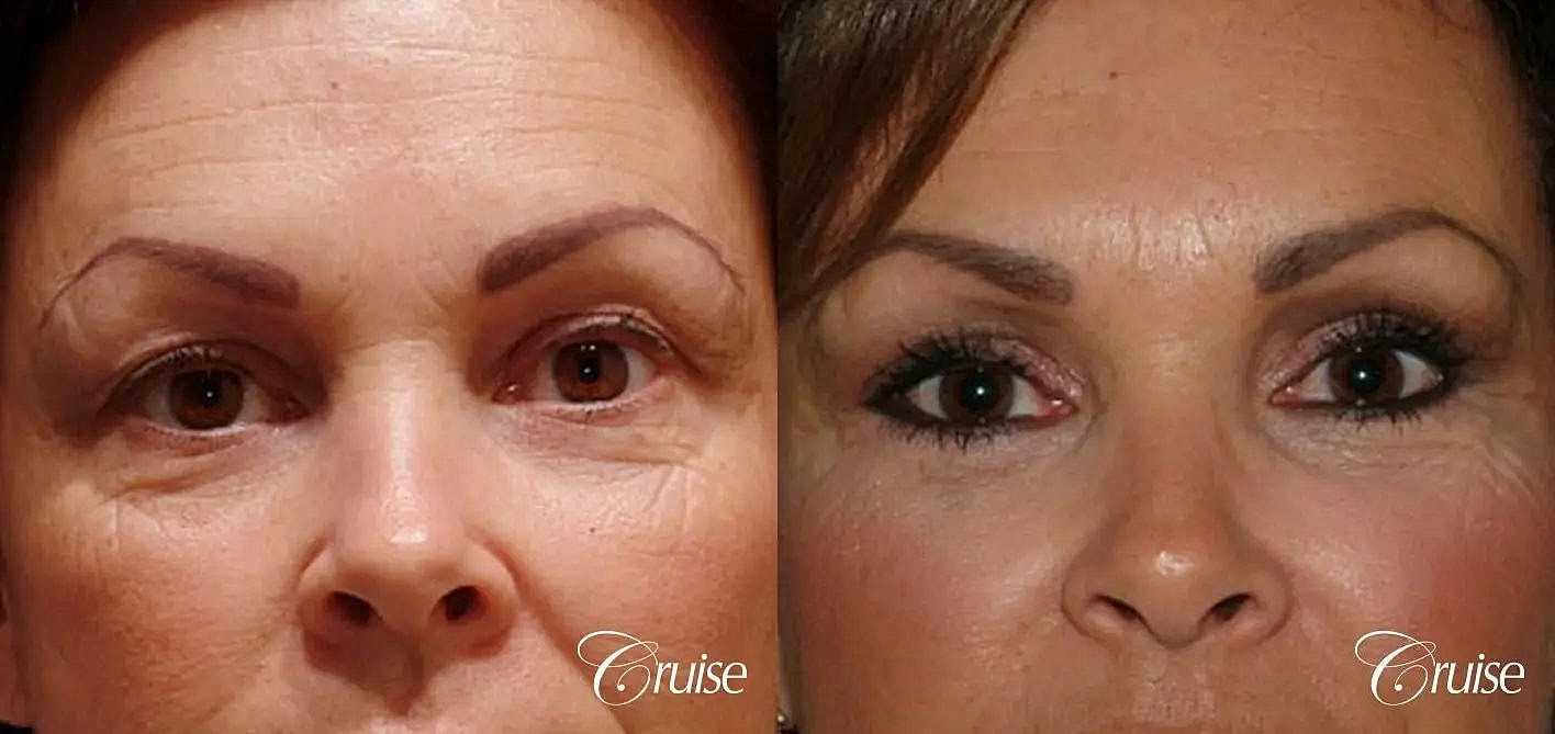 Blepharoplasty Before & After