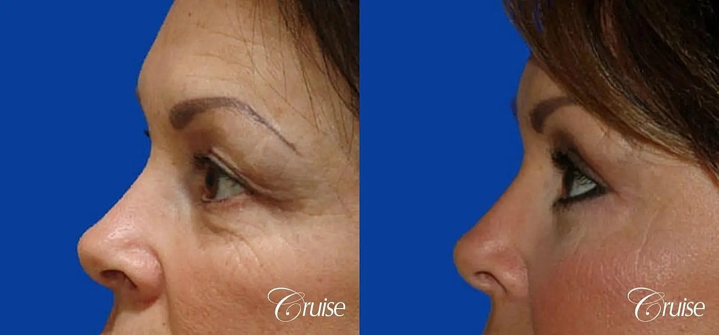 Blepharoplasty Before & After