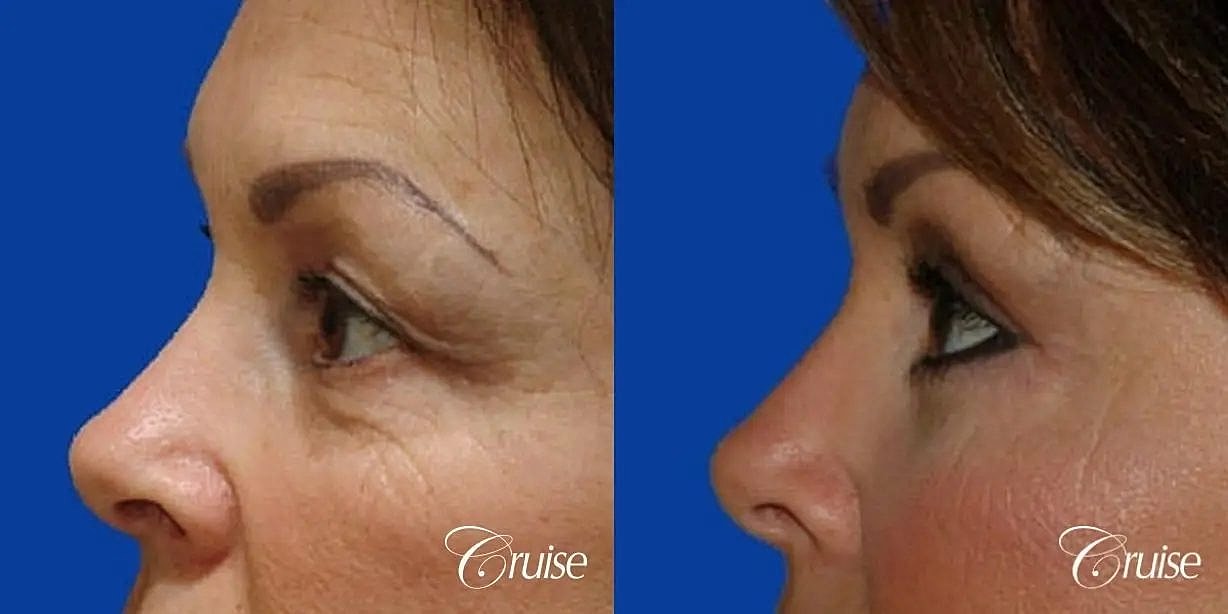 Blepharoplasty Before & After