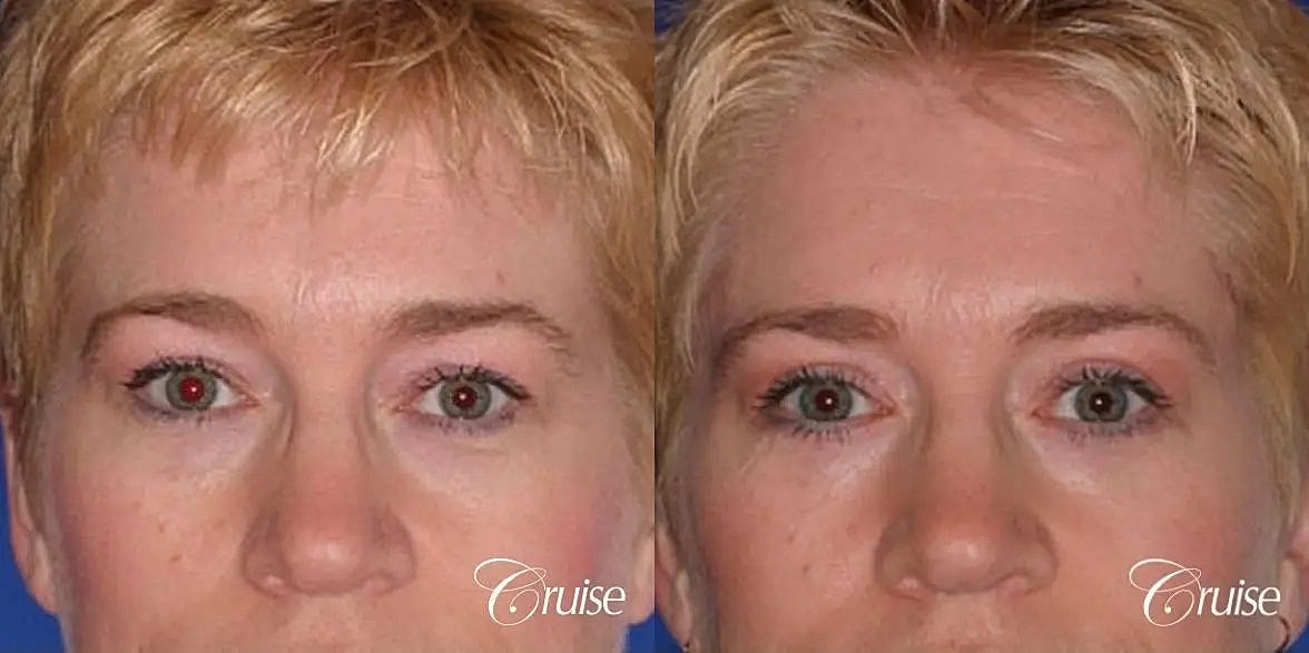 Blepharoplasty Before & After