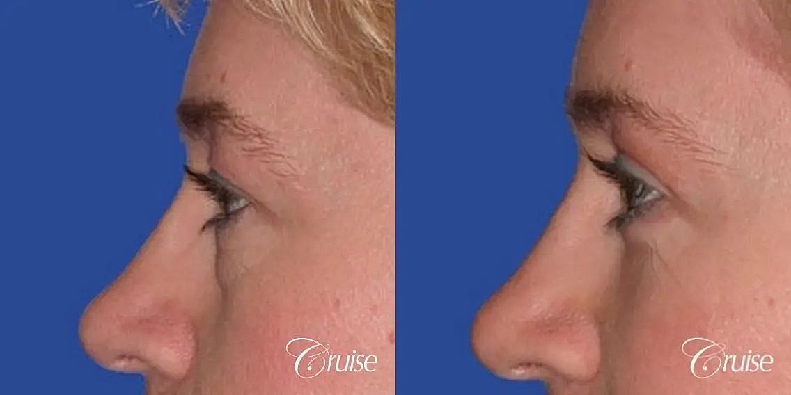 Blepharoplasty Before & After
