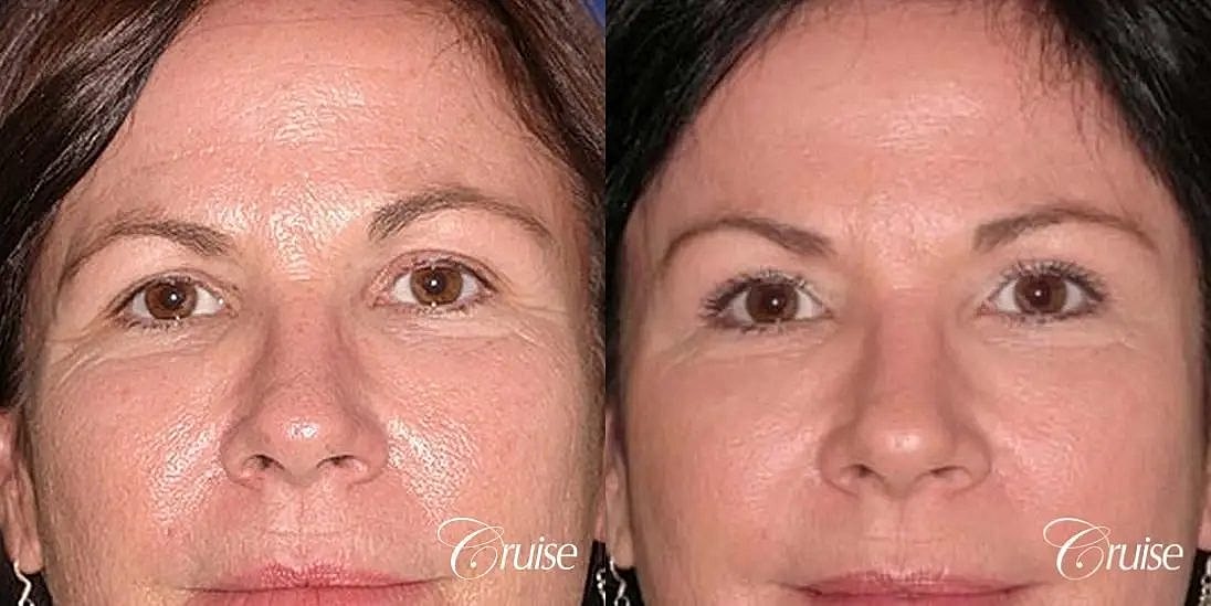 Blepharoplasty Before & After