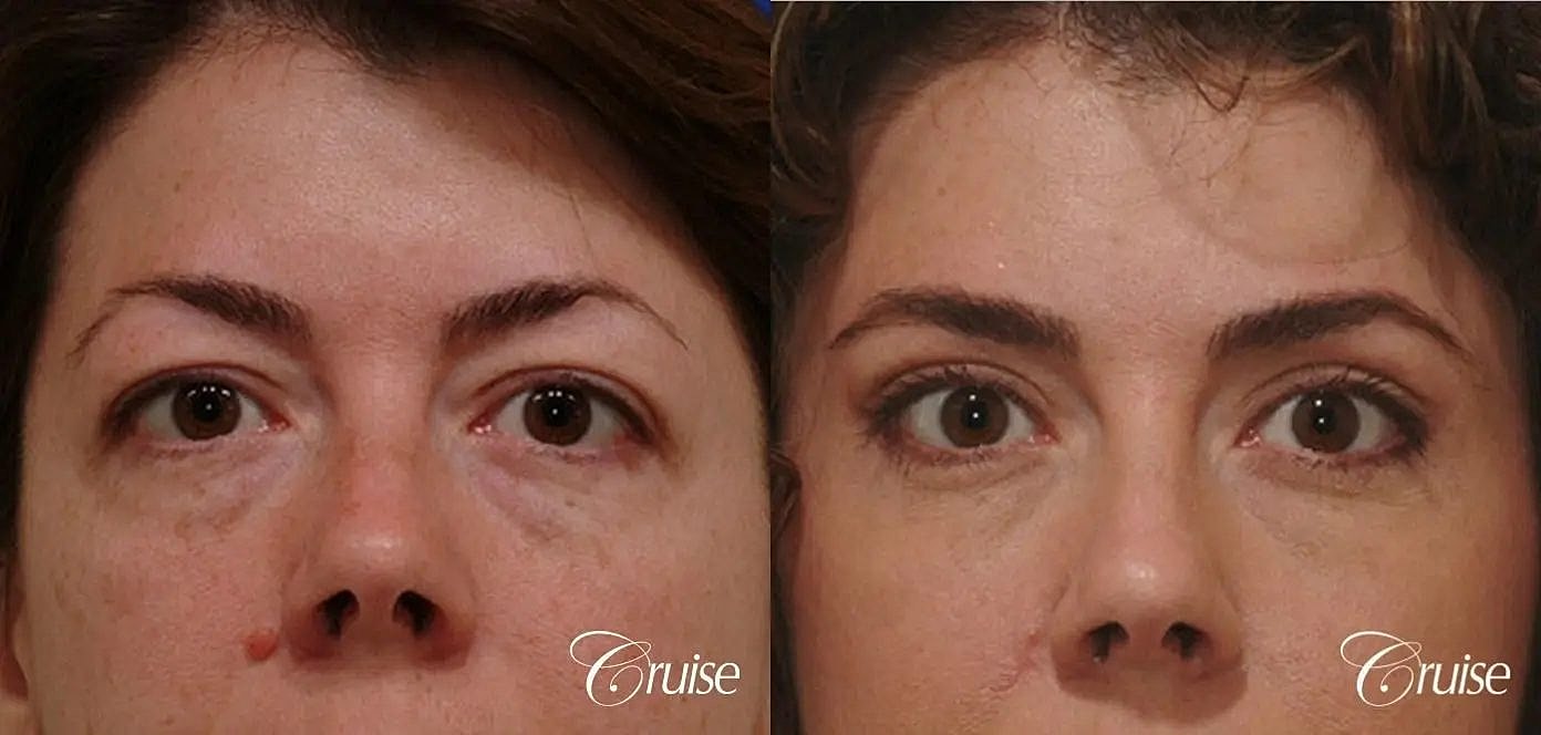 Blepharoplasty Before & After