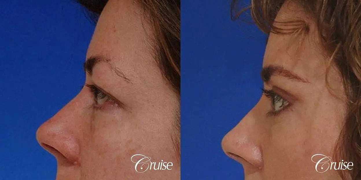 Blepharoplasty Before & After