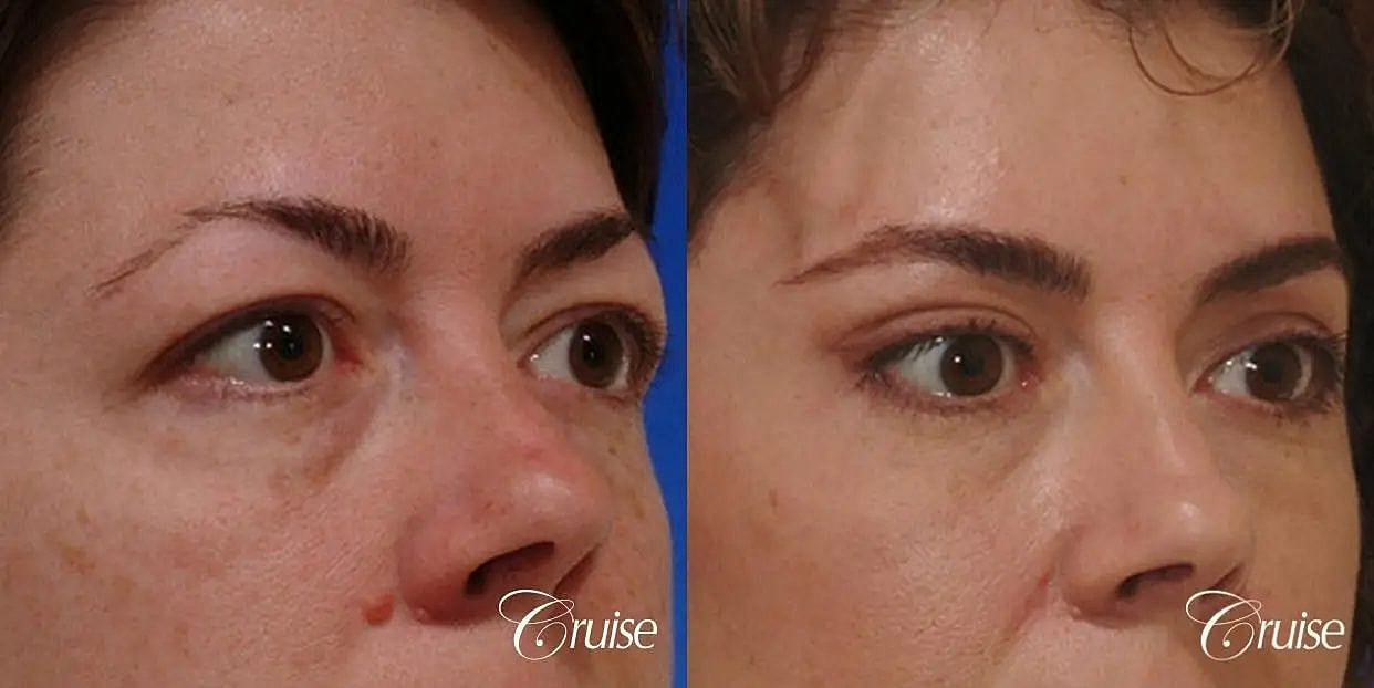 Blepharoplasty Before & After