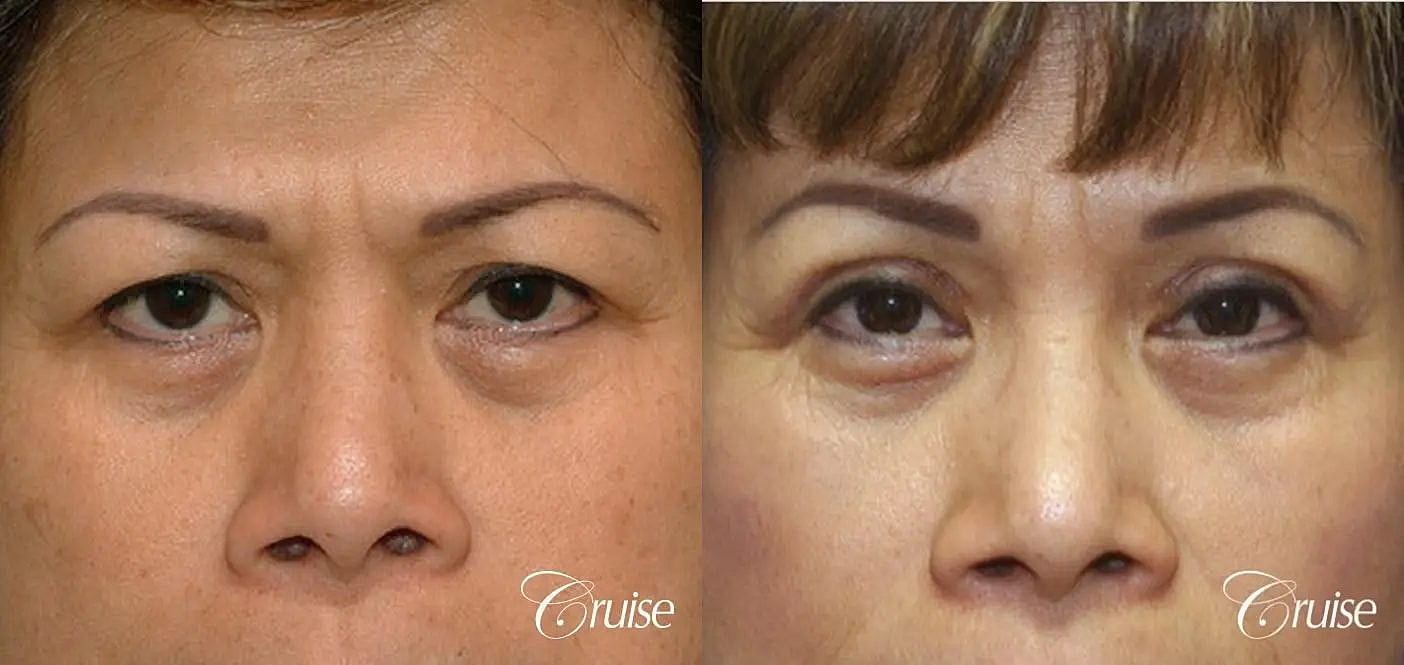 Blepharoplasty Before & After