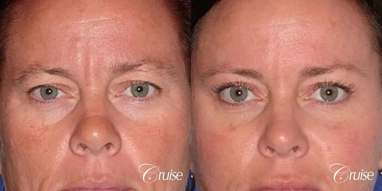 Blepharoplasty Before & After