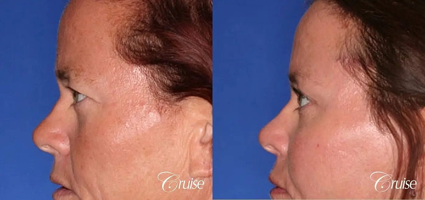 Blepharoplasty Before & After