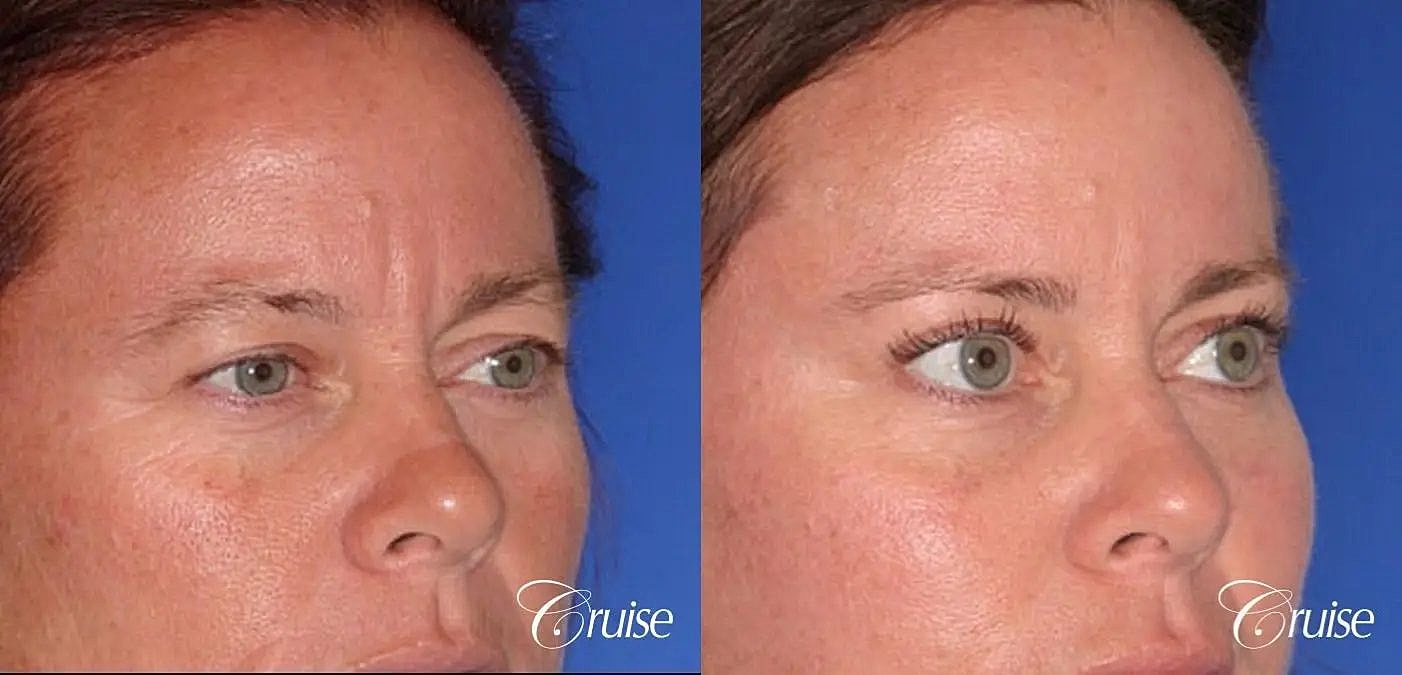Blepharoplasty Before & After