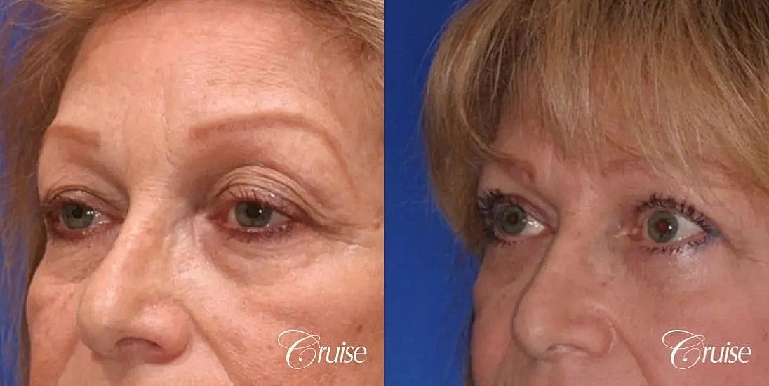 Blepharoplasty Before & After