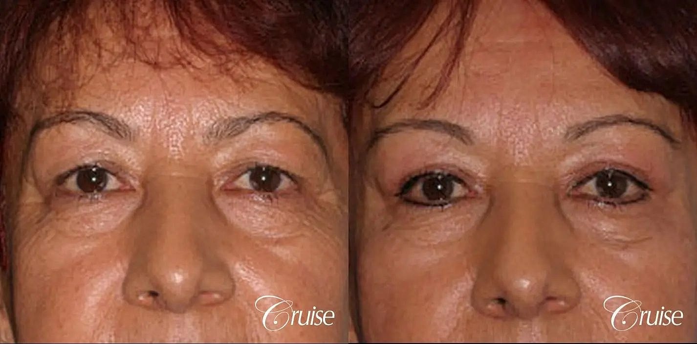 Blepharoplasty Before & After