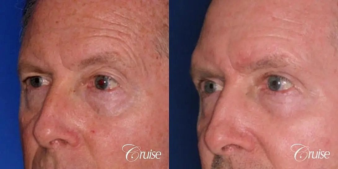 Blepharoplasty Before & After