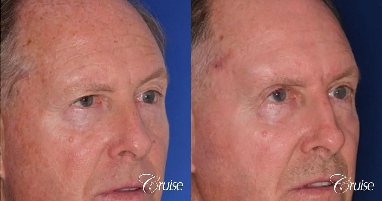 Blepharoplasty Before & After
